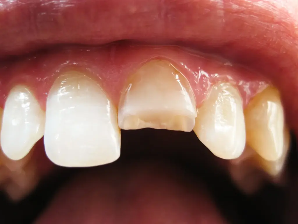 A chipped upper front tooth before bonding treatment