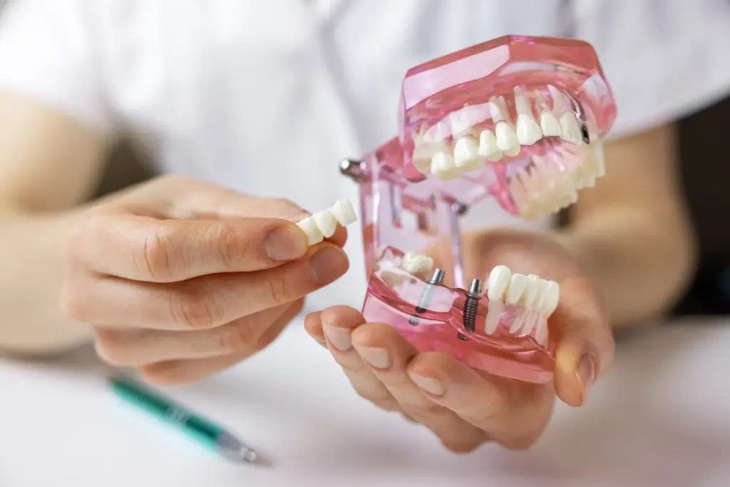 A dentist showing a dental bridge on a model of a human jaw
