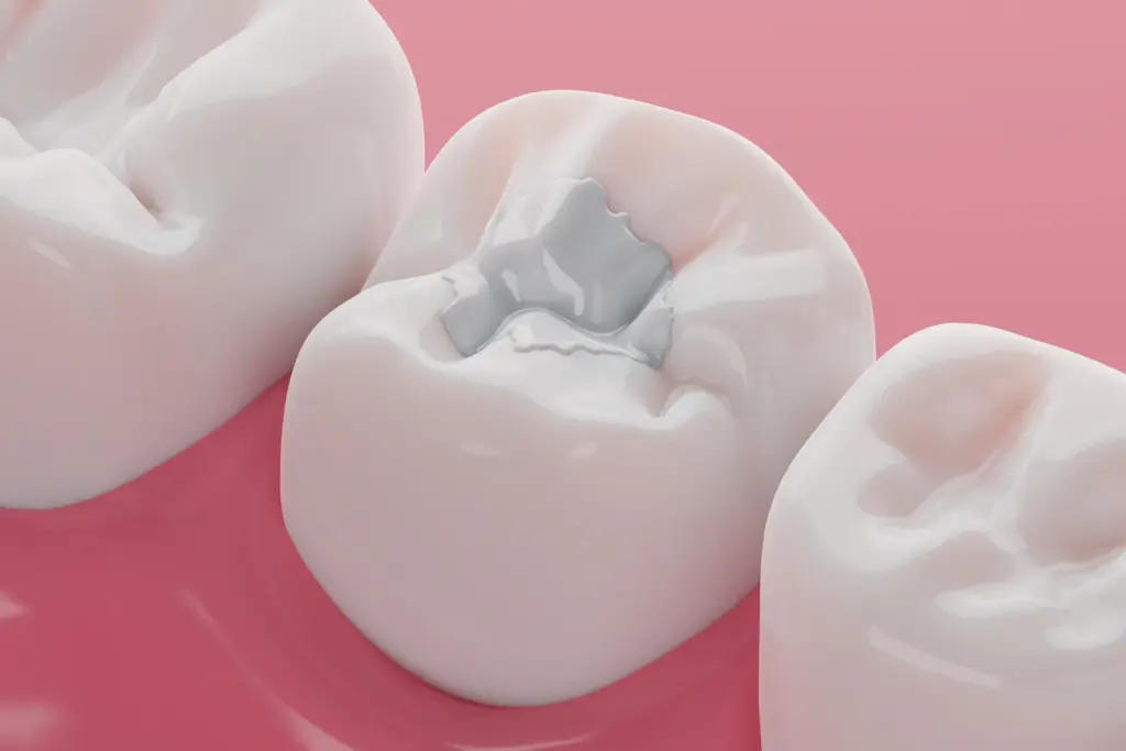 Close-up of a tooth restored with a white composite filling
