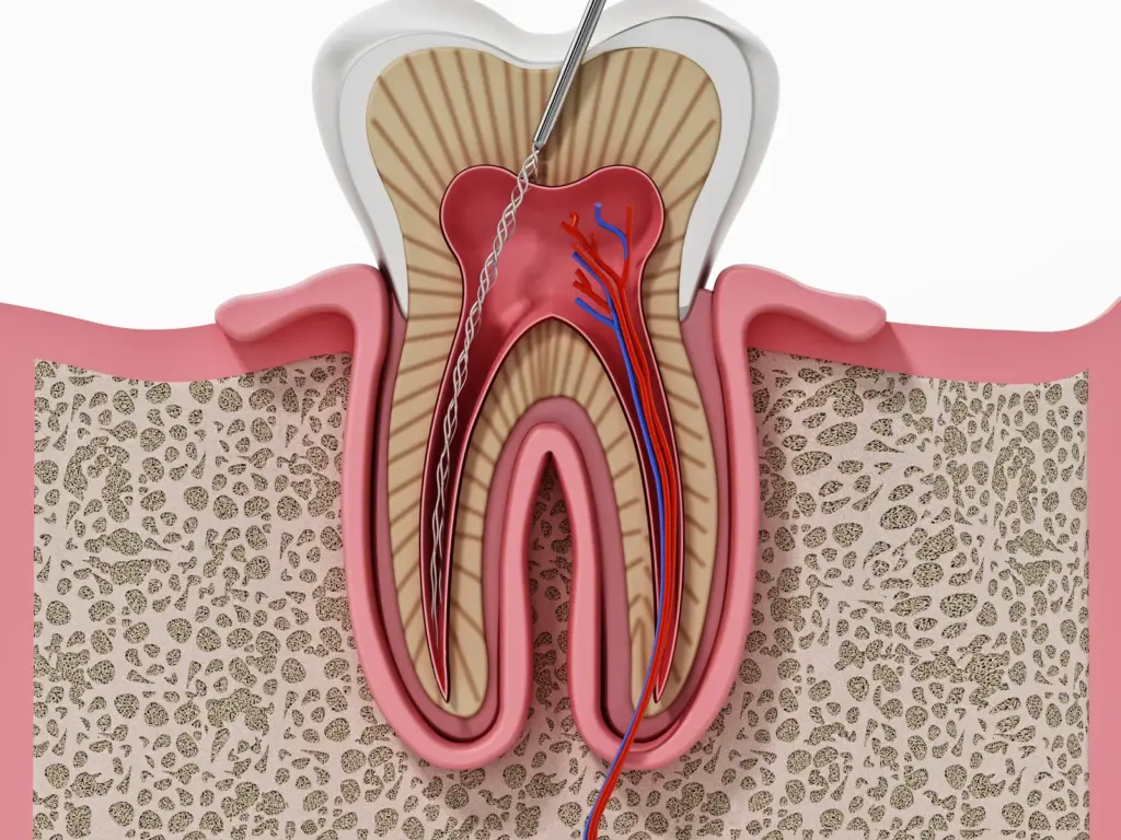 An illustration of root canal treatment inside a tooth