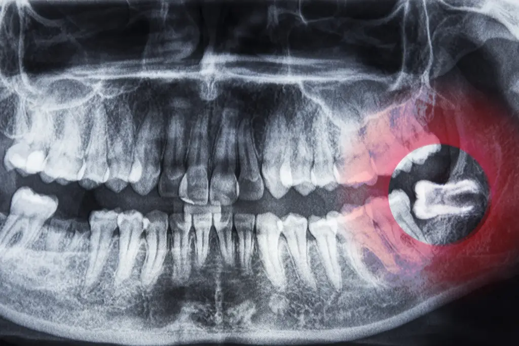 A dental x-ray showing an impacted wisdom tooth